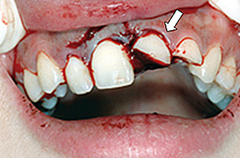 外傷（歯が折れた・唇が切れた）について