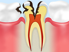 C3：歯の神経にまでおよんだむし歯