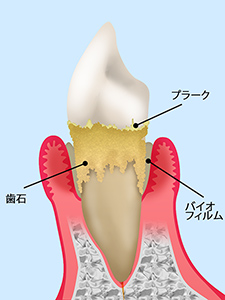 そもそも歯周病とは？